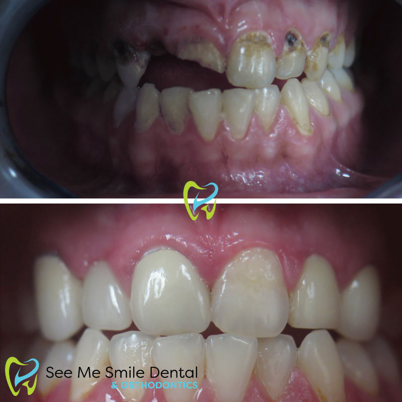 Implants, Crowns, and Veneers with Tooth Decay Santa Barbara CA