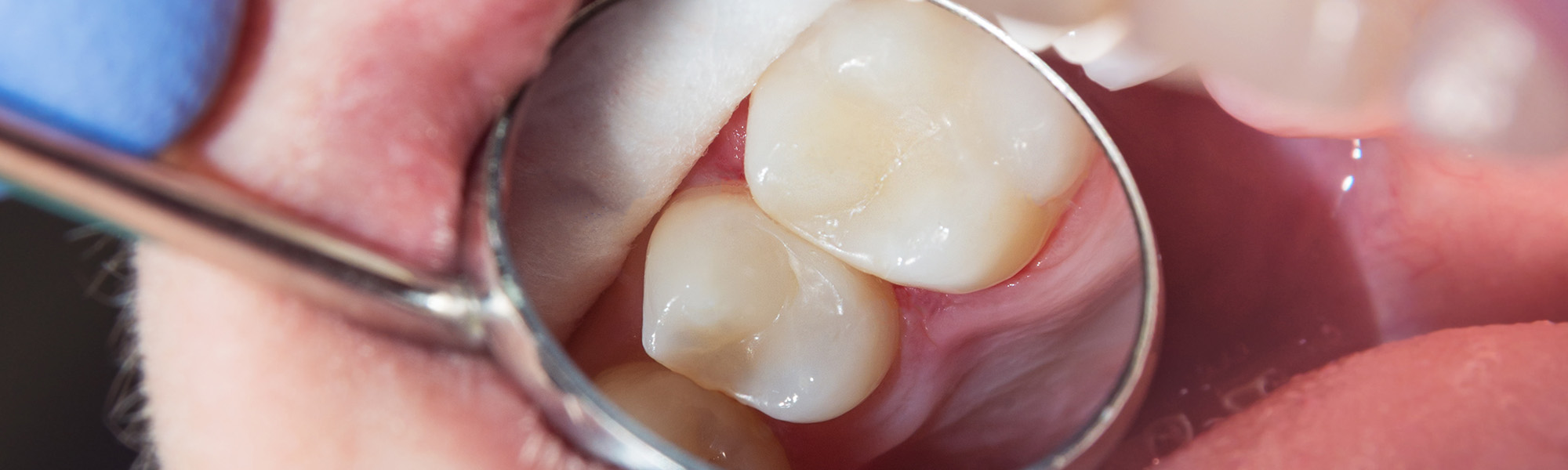 Dental Fillings in Santa Barbara: Types and Procedures