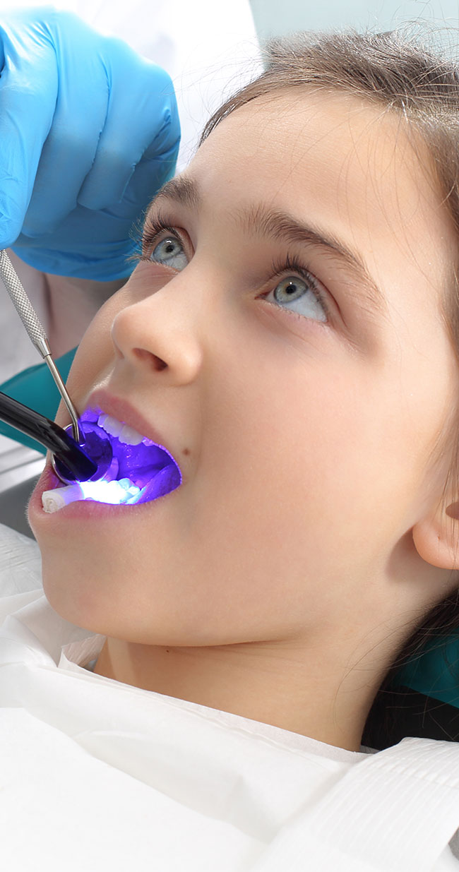 Teeth Sealant Santa Barbara CA