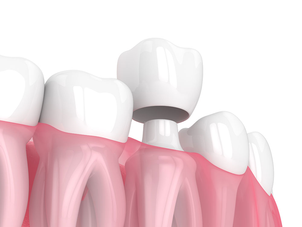 Dental Crowns Santa Barbara CA