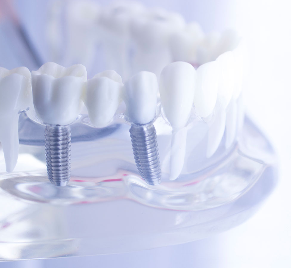 Dental Implants Santa Barbara