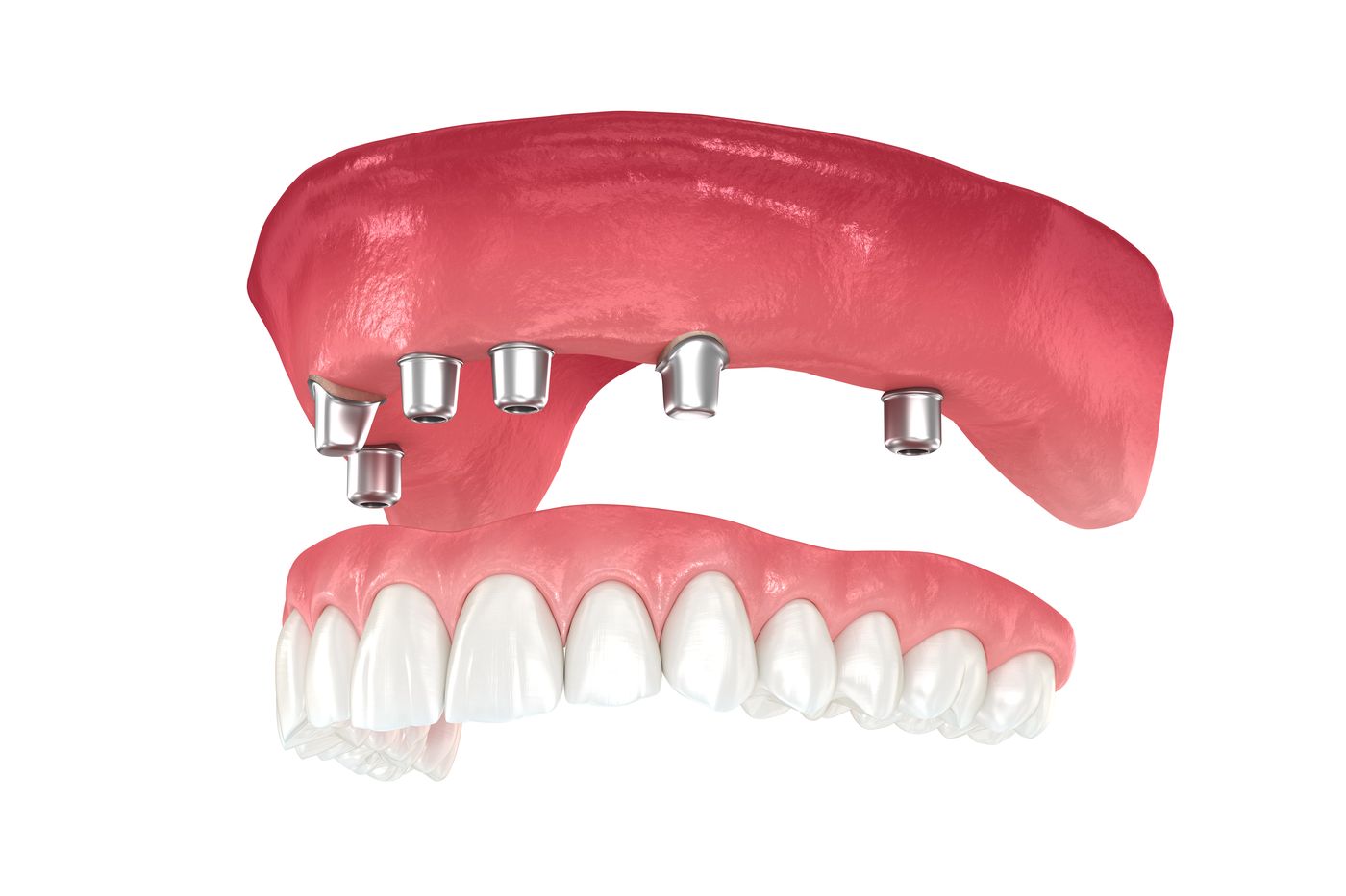 Dental prosthesis with metal implants and artificial teeth on white background