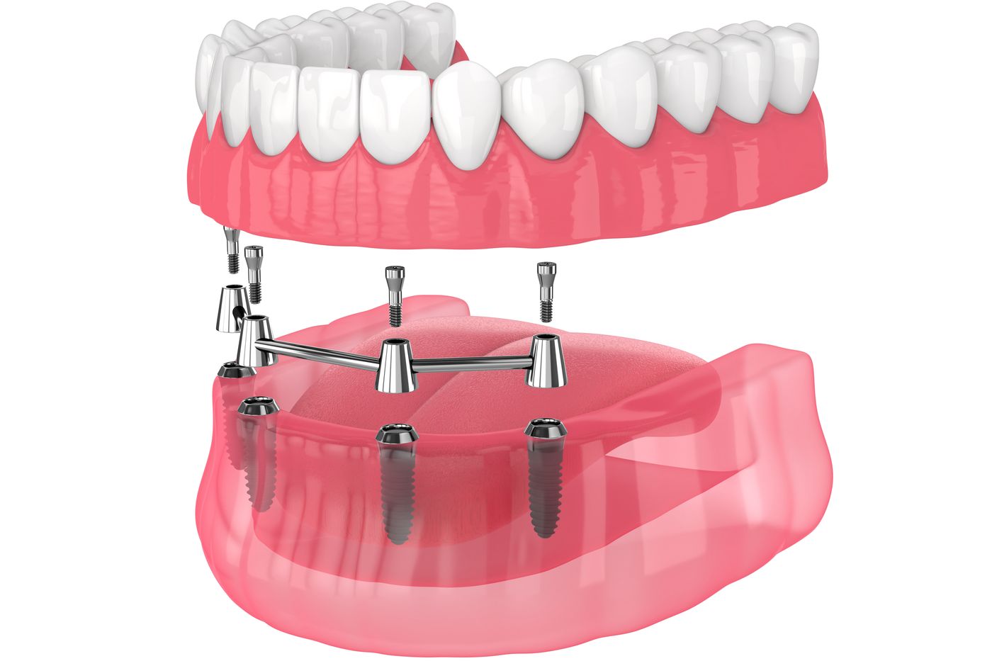 3D model of implant-supported dentures with metal posts and artificial teeth