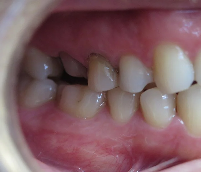 emergency dentist Santa Barbara Before