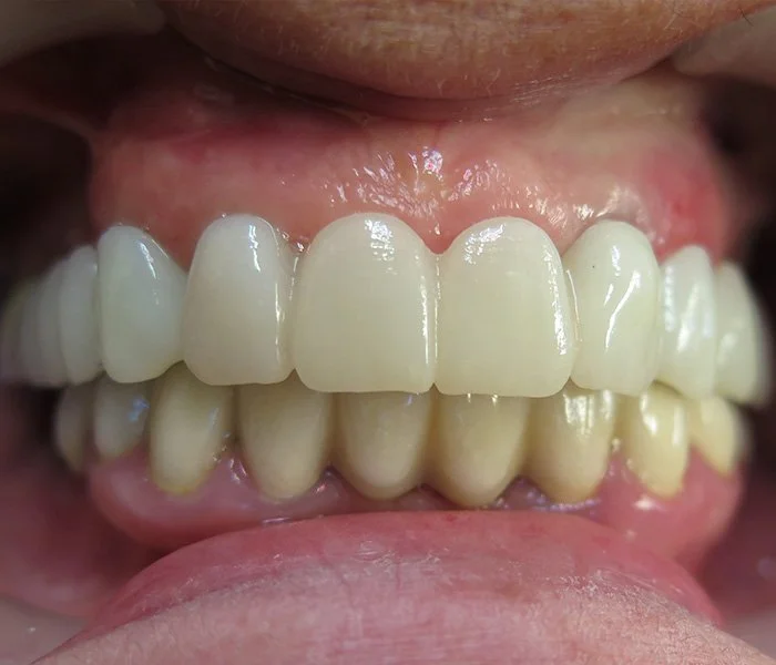 Dental Implants Santa Barbara After