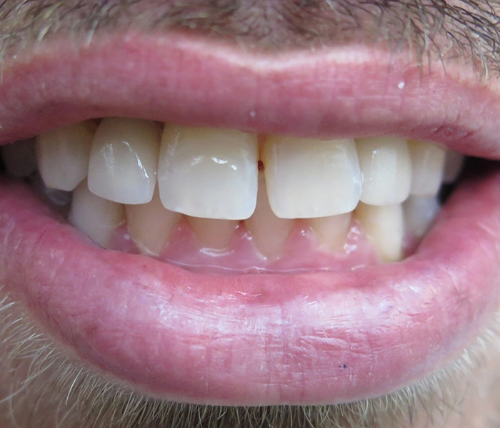Dental Implants Santa Barbara After