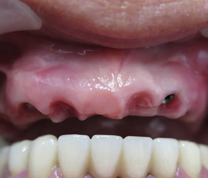 Dental Implants Santa Barbara Before