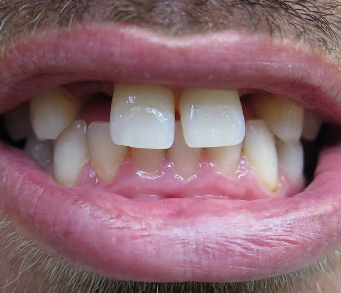 Dental Implants Santa Barbara Before